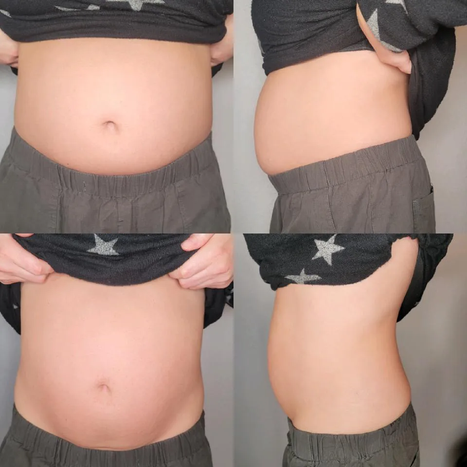 Four-view abdomen comparison, before and after InstaSculpting sessions