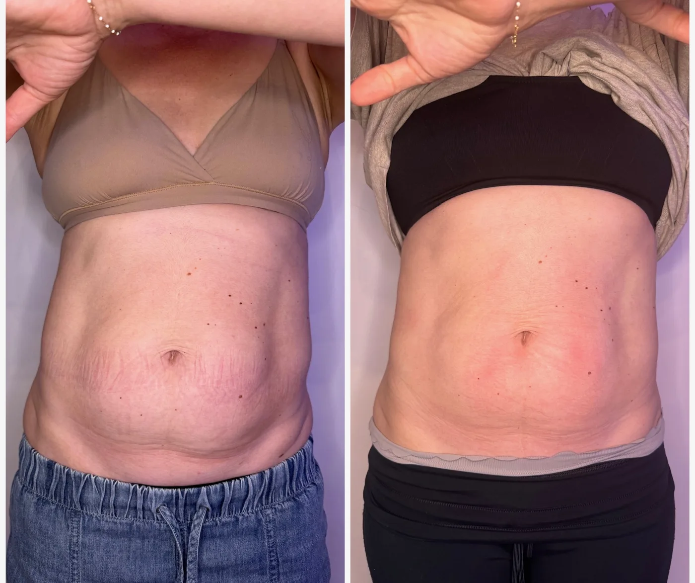 Front abdomen comparison, before and after InstaSculpting sessions