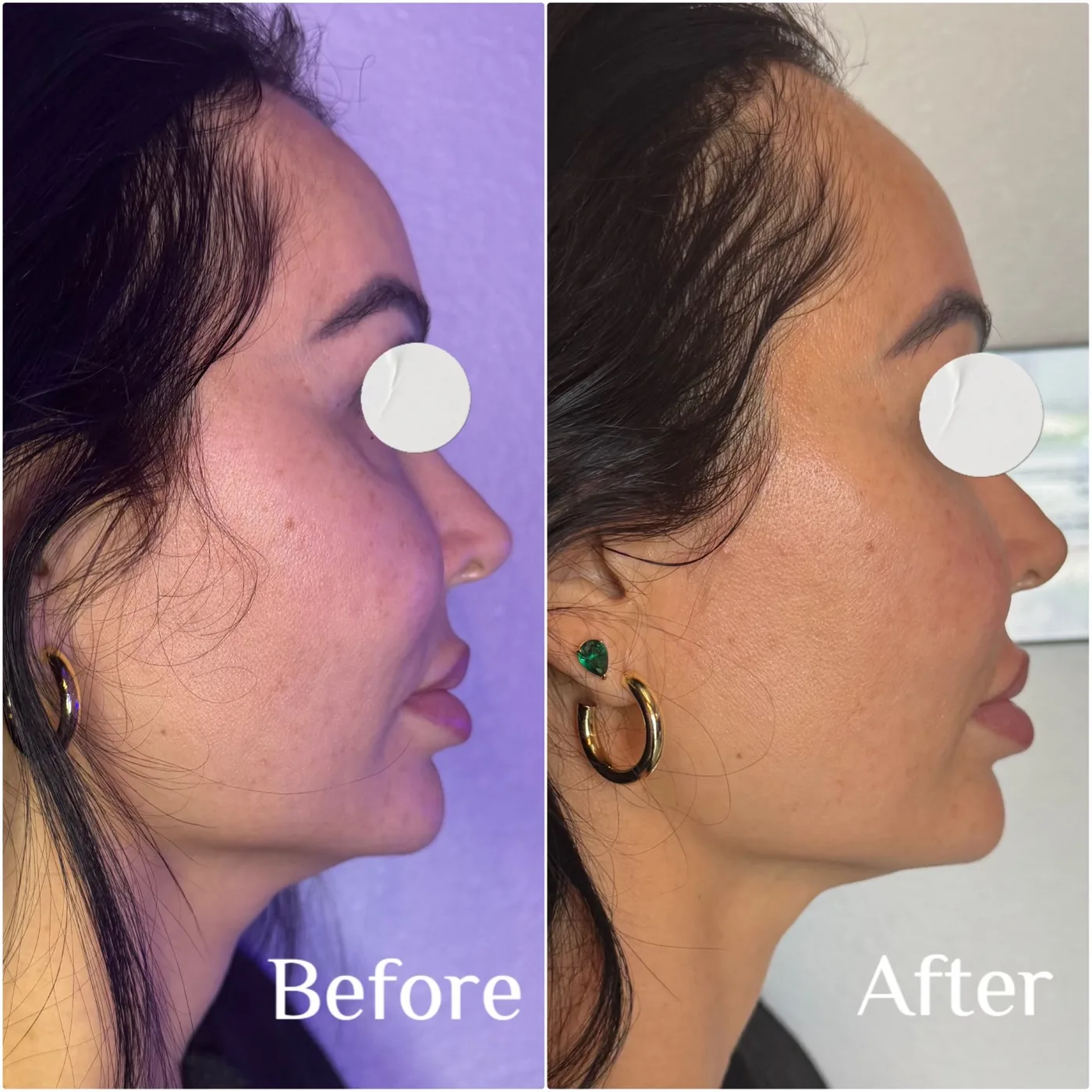 Facial profile comparison, before and after InstaSculpting facial sessions