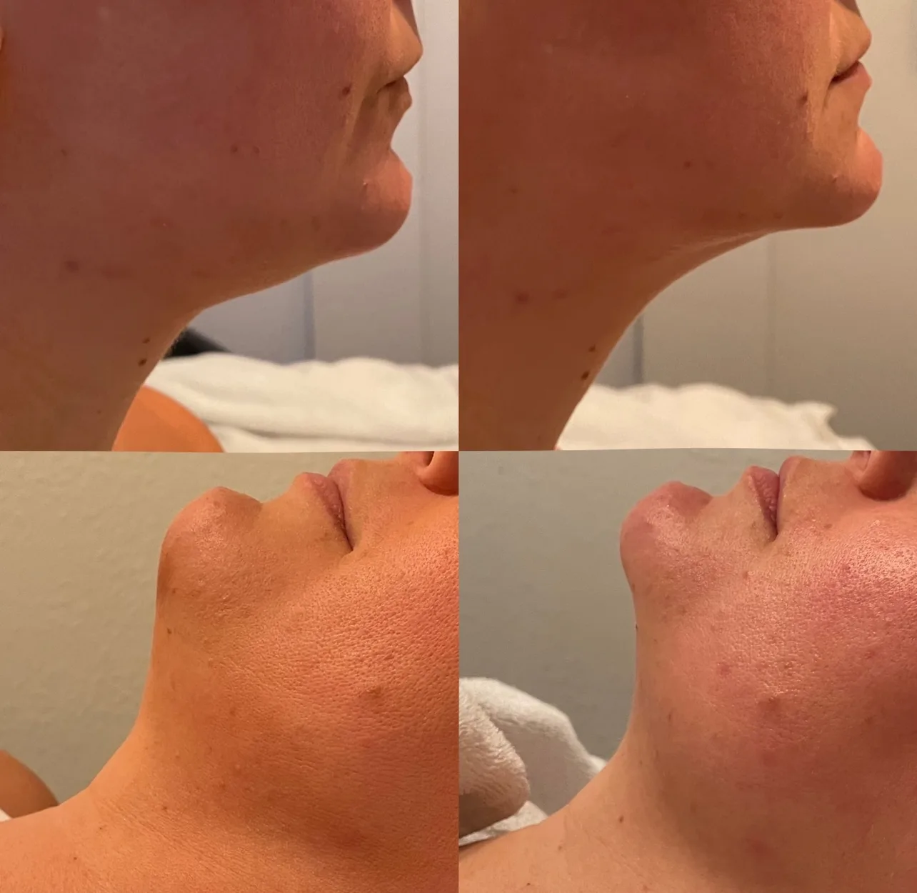 Jawline and neck comparison, before and after InstaSculpting sessions