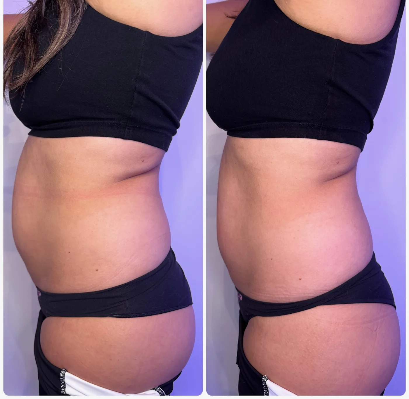 Side-profile abdomen comparison, before and after InstaSculpting sessions