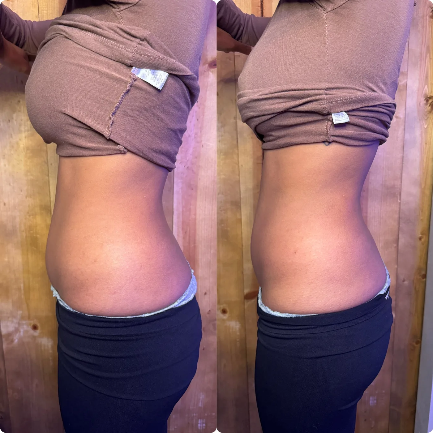 Waistline comparison, before and after InstaSculpting sessions